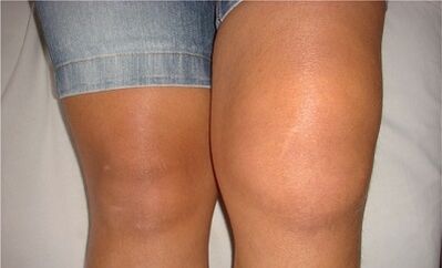 Causes of arthrosis of the knee joint