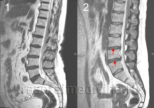 The spine osteochondrosis