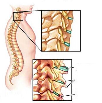 Comparison of healthy and sick vertebrae