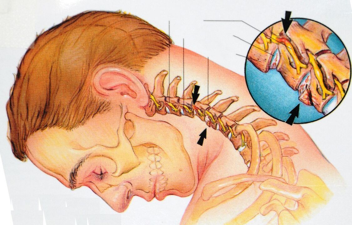 The cervical region osteochondrosis