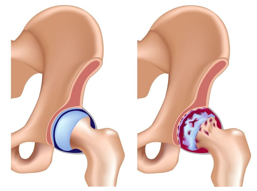 A healthy joint and joint joint of the hip joint